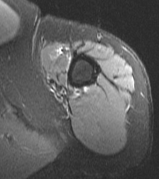 Figure 4 for case Tear of tendon of long head of biceps brachii sp tenodesis (RID1944)